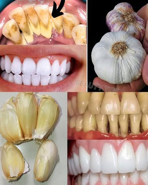 Natural Teeth Whitening – Say Goodbye to Yellowing and Tartar