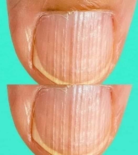 Having Striped Nails Could Mean That Your…