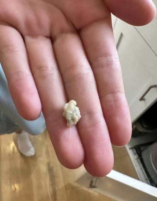Here’s what you need to know about tonsil stones – the weird pimple-like growths in your throat
